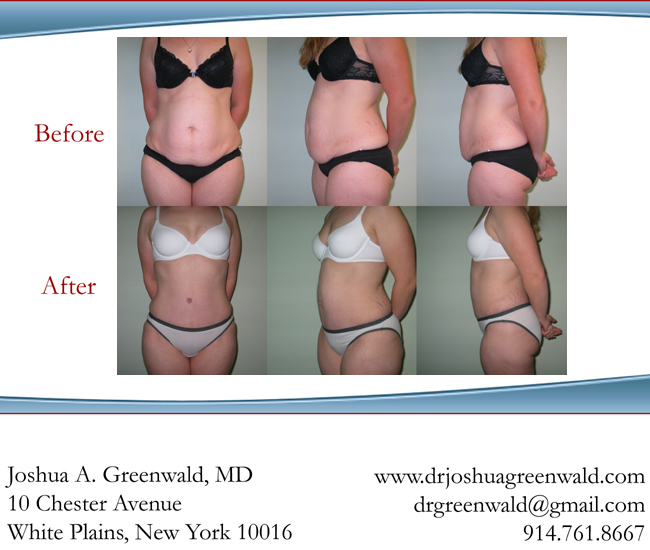 Before and After Tummy Tuck Photos New York Westchester County