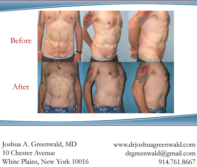 Tummy Tuck (Abdominoplasty) Before and After Pictures Case 97, Gilbert, AZ